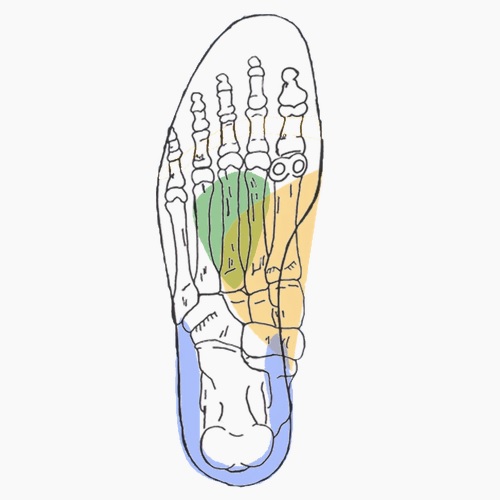 Semelles orthopédiques sur mesure pour entorse de Chopart