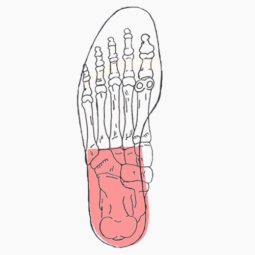 Semelles orthopédiques sur mesure pour genu récurvatum
