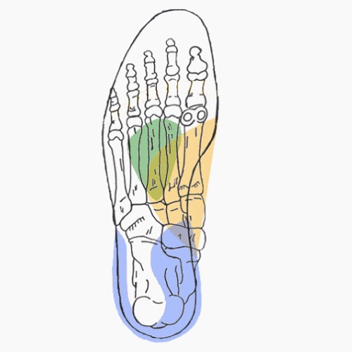 Semelles orthopédiques sur mesure pour genu valgum