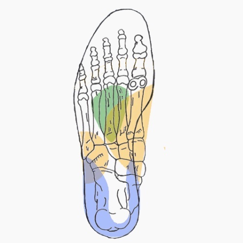 Semelles orthopédiques sur mesure pour genu varum
