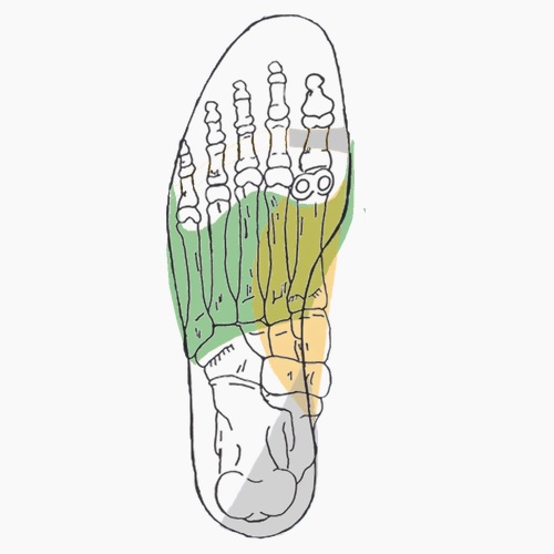 Semelles orthopédiques sur mesure pour hallux valgus