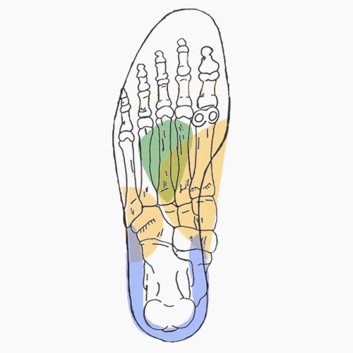Semelles orthopédiques sur mesure pour pathologie de lisfranc