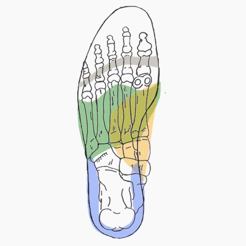 Semelles orthopédiques sur mesure pour pied rhumatoide