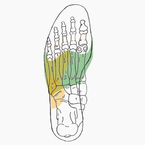 Semelles orthopédiques sur mesure pour quintus varus