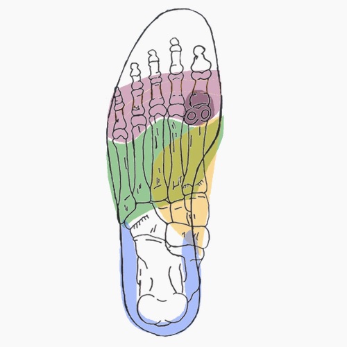 Semelles orthopédiques sur mesure pour sesamoidite d'appui