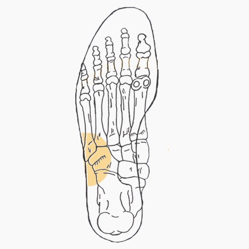 Semelles orthopédiques sur mesure pour syndrome du cuboide