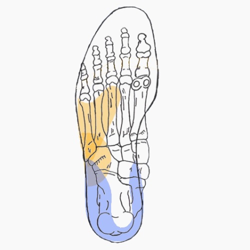 Semelles orthopédiques sur mesure pour syndrome de l'essuie glace