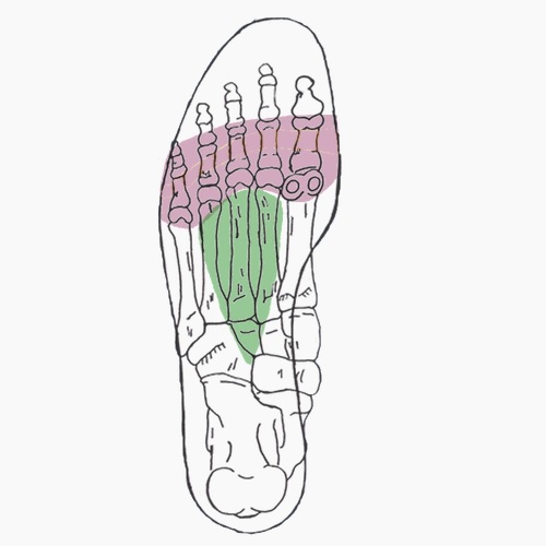 Semelles orthopédiques sur mesure pour syndrome de Morton
