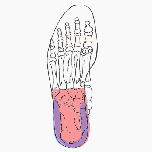 Semelles orthopédiques sur mesure pour talonnade