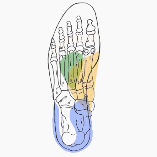 Semelles orthopédiques sur mesure pour valgus calcanéen