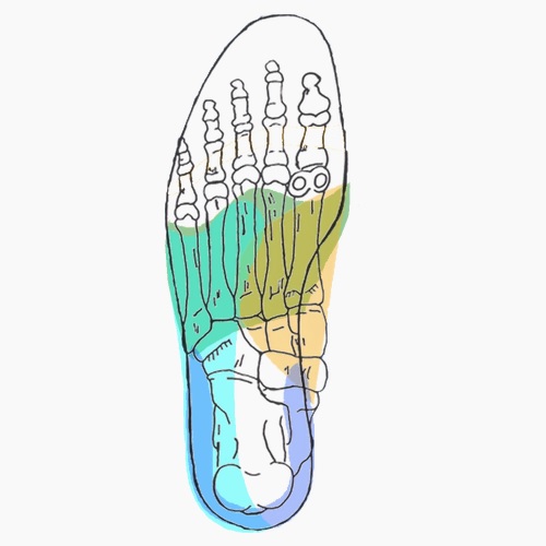 Semelles orthopédiques sur mesure pour varus calcanéen